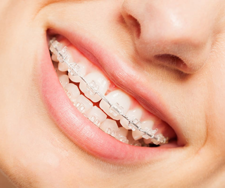  Clarity™ Advanced ceramic braces