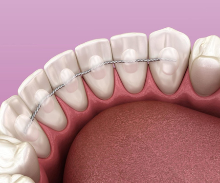  Types of retainers